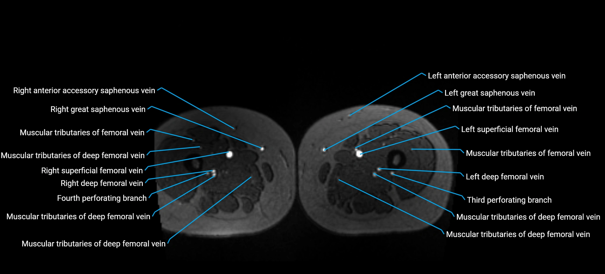 MRV abdomen pelvis & lower limb axial cross sectional anatomy labelled MRI image 255 (1).webp
